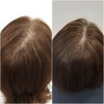 Sydney hair loss