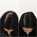 Sydney hair loss