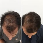 Hair loss treatment
