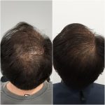 Sydney hair treatment